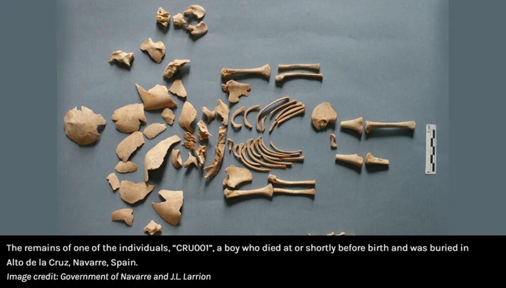 שרידי ילד עם תסמונת דאון מלפני כ-2,600 שנה. צילום: ממשלת נבארו וג'יי. אל לריון